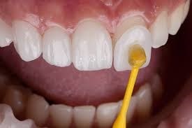 اهمیت مشاوره دندانپزشکی قبل از دریافت ونیرها