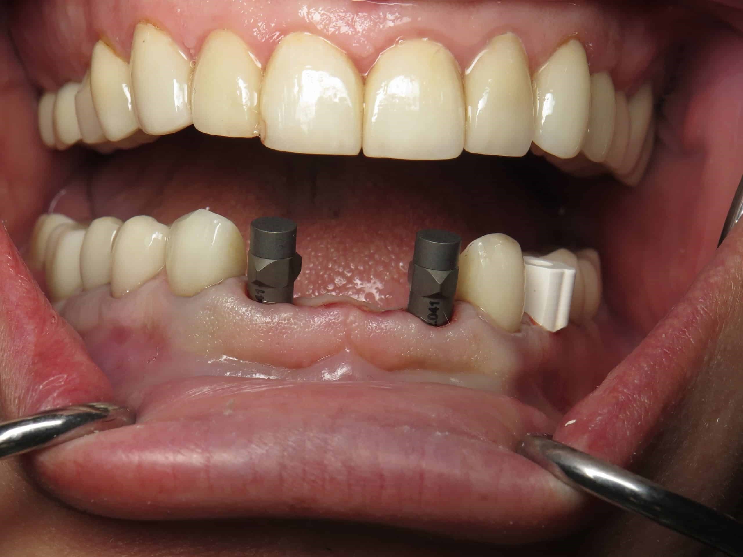0 min - آیا می توان به جای دندان های جلو ایمپلنت کاشت؟