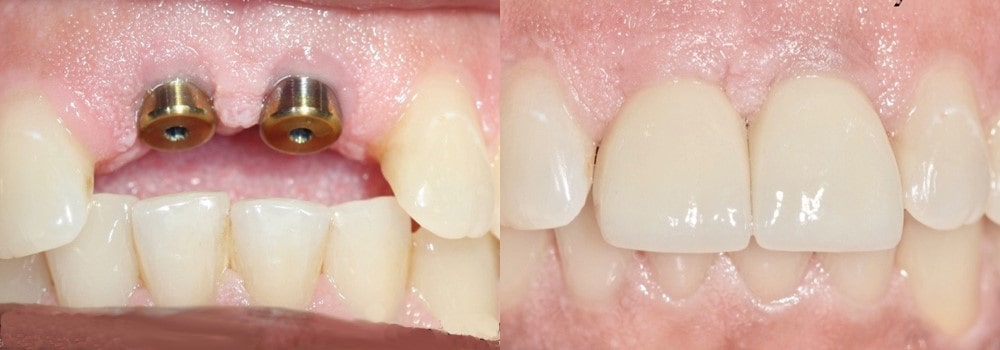 آیا می توان به جای دندان های جلو ایمپلنت کاشت؟