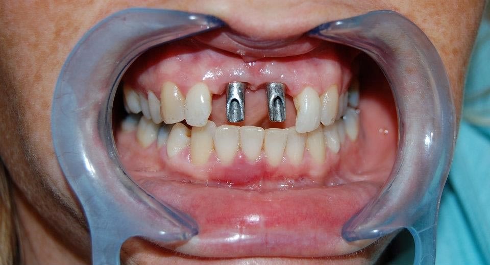 بهبودی پس از کاشت ایمپلنت دندانی جلو