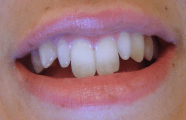 0 min - آیا می توان دندان های بلند را کوتاه کرد؟