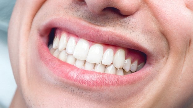 0 min - صاف و یکدست کردن دندان ها بدون بریس ارتودنسی