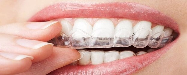 آیا می توان دندان ها را به طور طبیعی صاف کرد؟