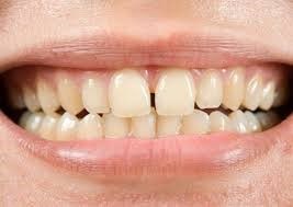 افزودن فاصله بین دندان ها