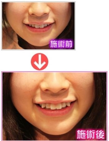 دندان های نیش یا تغییر شکل دندان