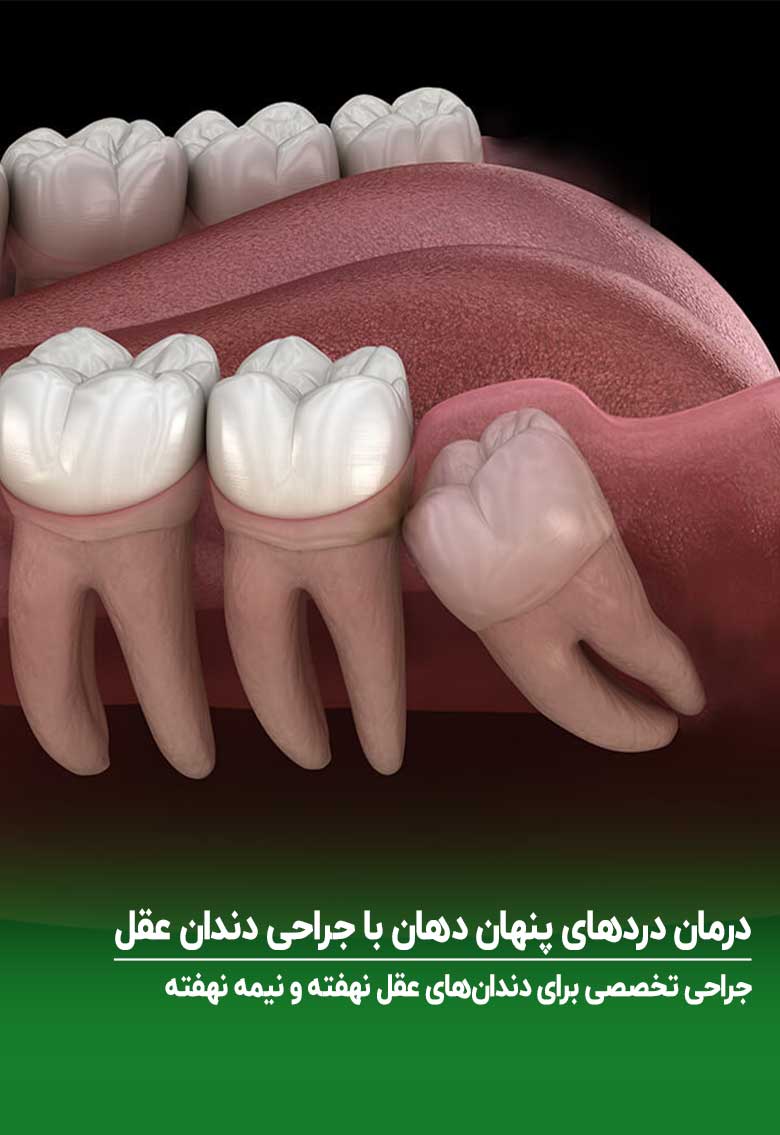 جراحی دندان عقل