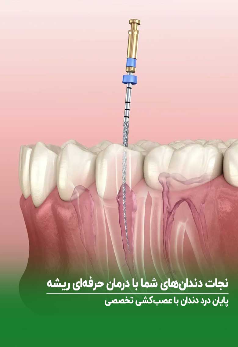 درمان ریشه عصبکشی دندان