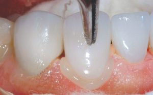 بیشتر از چه موادی برای تعمیر ترمیم های پرسلن آسیب دیده استفاده می شود؟