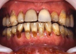پیوند عضو به دلیل مشکلات دندانپزشکی می تواند پیچیده شود.