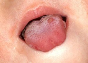 چه چیزی باعث سندرم سوزش دهان می شود؟
