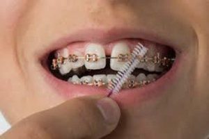 چگونه فاصله بین دندان ها (دیاستم) را برطرف کنیم؟