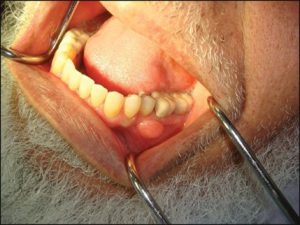 ویژگی های بالینی لیپوم های دهانی چیست؟