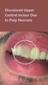 چه چیزی باعث نکروز پالپ می شود؟