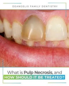 دندانی که دچار نکروز پالپ شده است، چه شکلی است؟